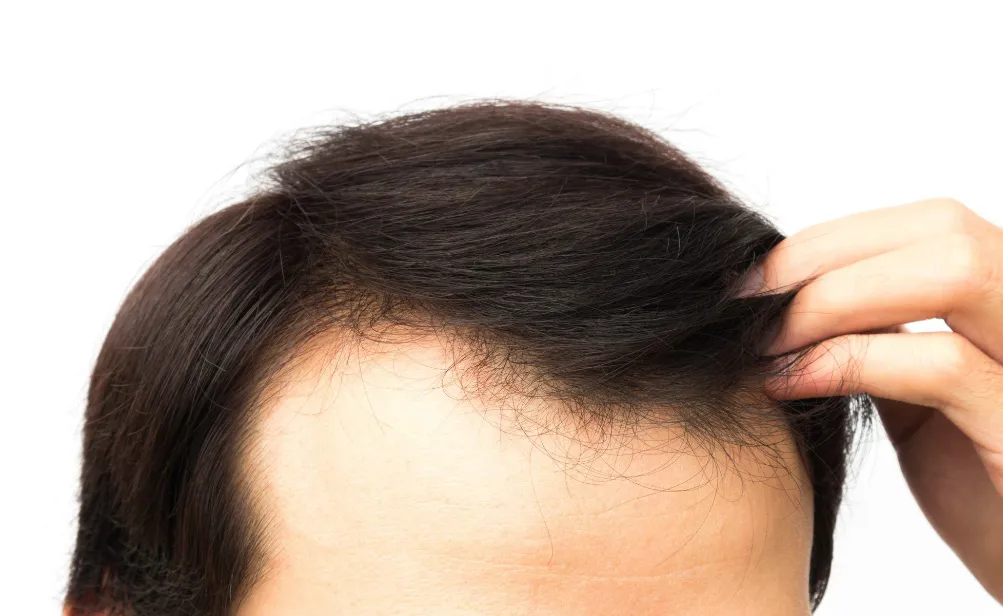 The Process of Capillus Lawsuit