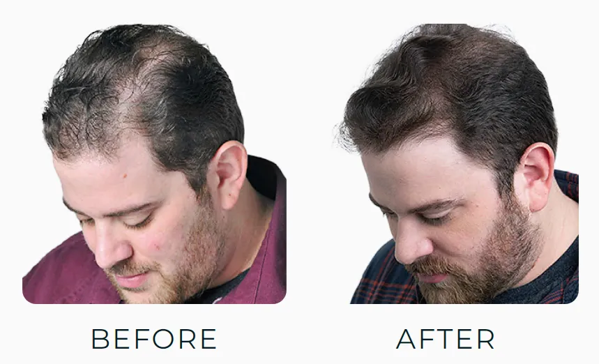 Theradome Before and After Pictures