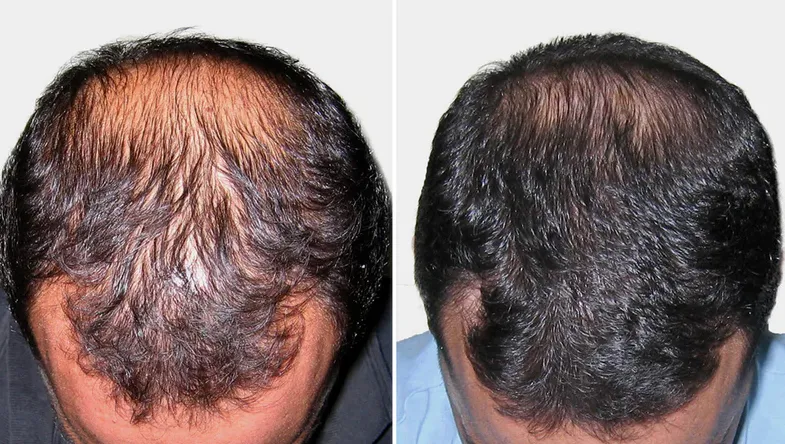 Hairmax Ultima 9 Before and After