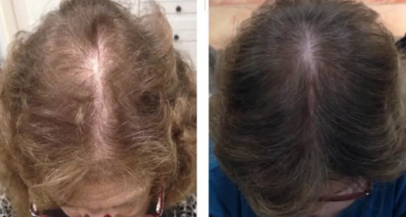 Theradome Before and After