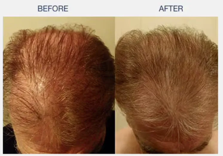 illumiflow 272 Laser Cap for Hair Growth before and after results