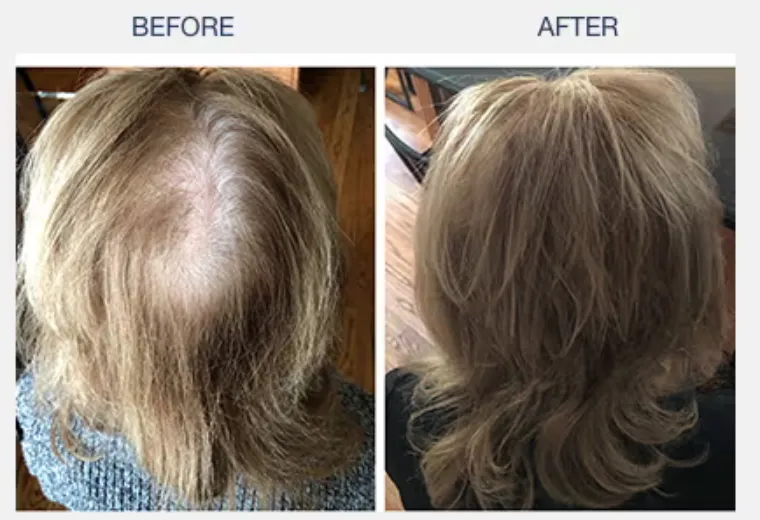 illumiflow 272 Laser Cap for Hair Growth before and after results