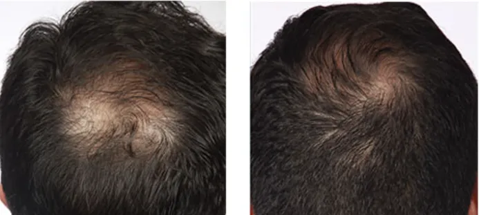 Hairmax Laserband Before and After