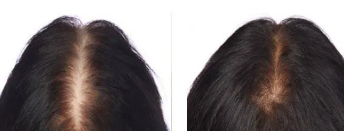 Hairmax Ultima 9 Before and After