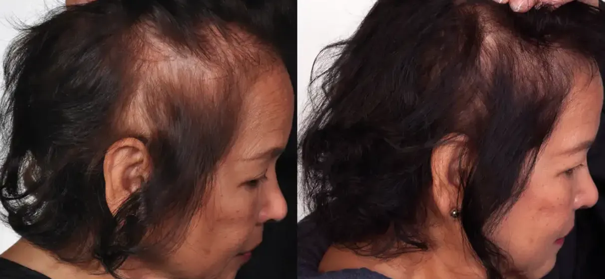 Before and After Results Theradome Pro LH80