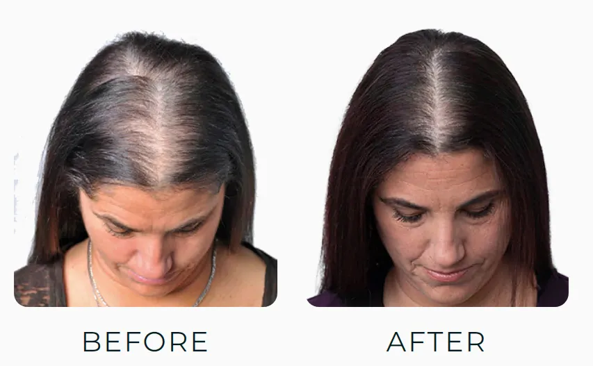 Theradome Before and After Pictures