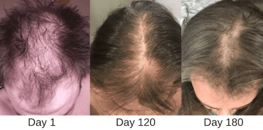 Kiierr Laser Cap – Before and After Photos