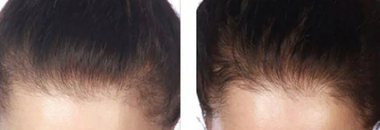 Hairmax Laserband 82 before and after results
