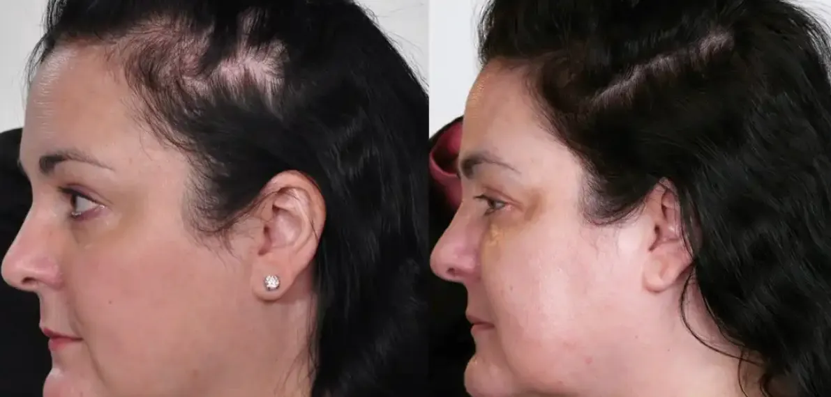 Before and After Results Theradome Pro LH80