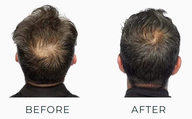 Theradome Before and After Pictures