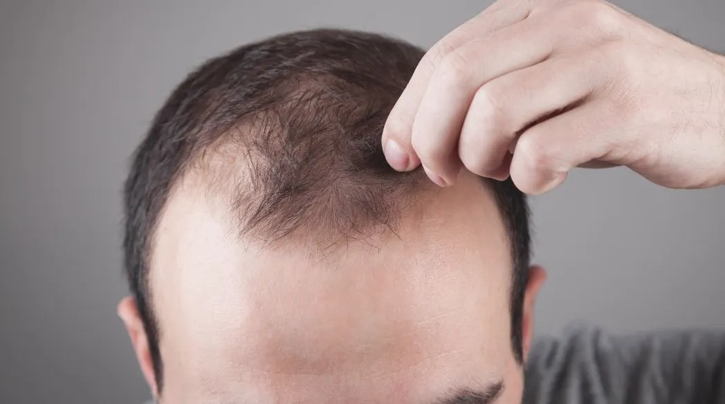 What Caused Hair Loss?