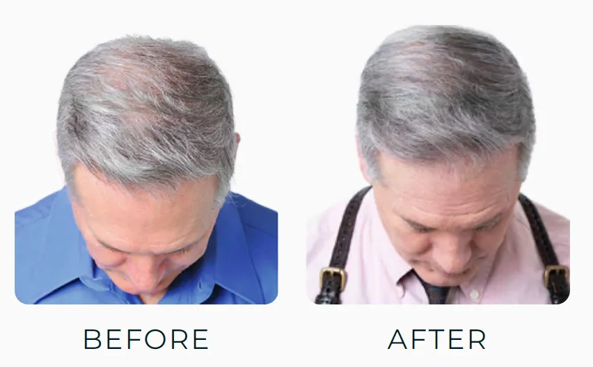 Theradome Before and After Pictures