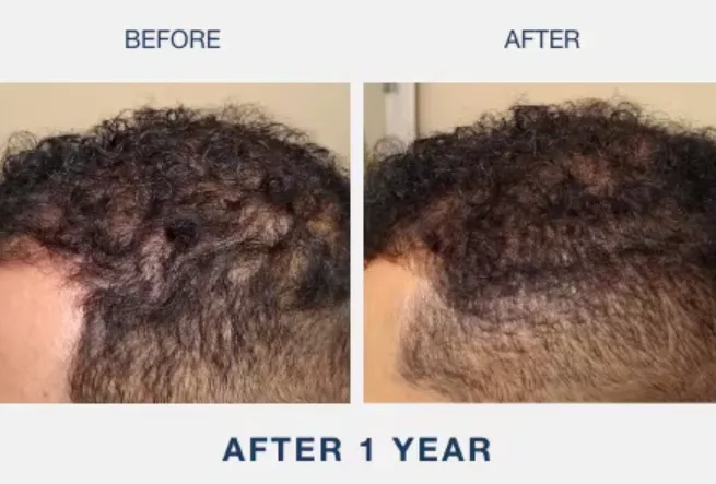 illumiflow Before and After Photos