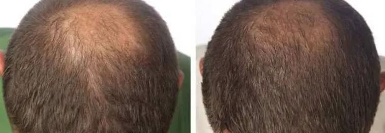 Hairmax Laserband 82 before and after results