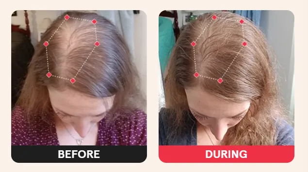 iRestore Laser Cap – Before and After Photos