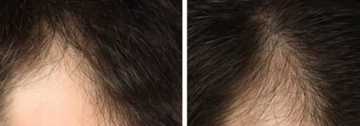 Hairmax Laserband 82 before and after results