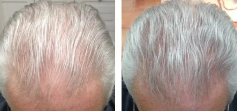 Theradome Before and After