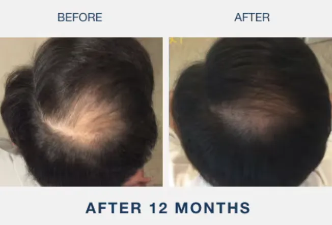 illumiflow Before and After Photos