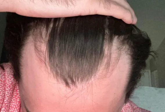 Capillus Hair Cap vs. Alternatives