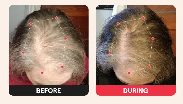 iRestore Laser Cap – Before and After Photos