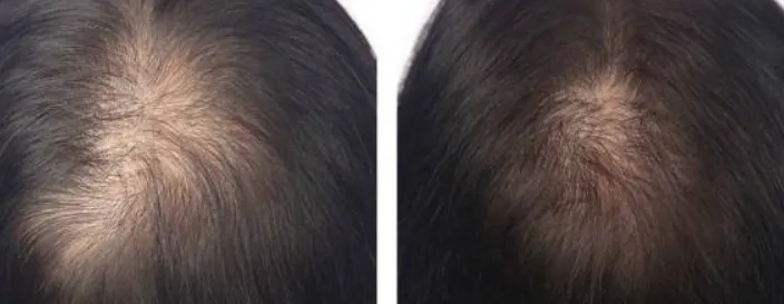 Hairmax Ultima 9 Before and After