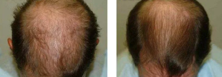 Hairmax Laserband 82 before and after results