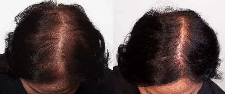 Theradome Before and After