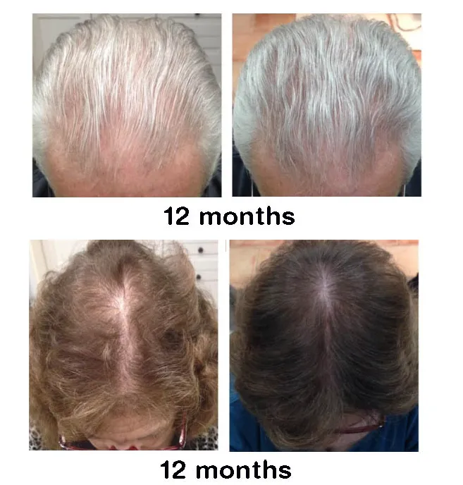 Theradome Before and After