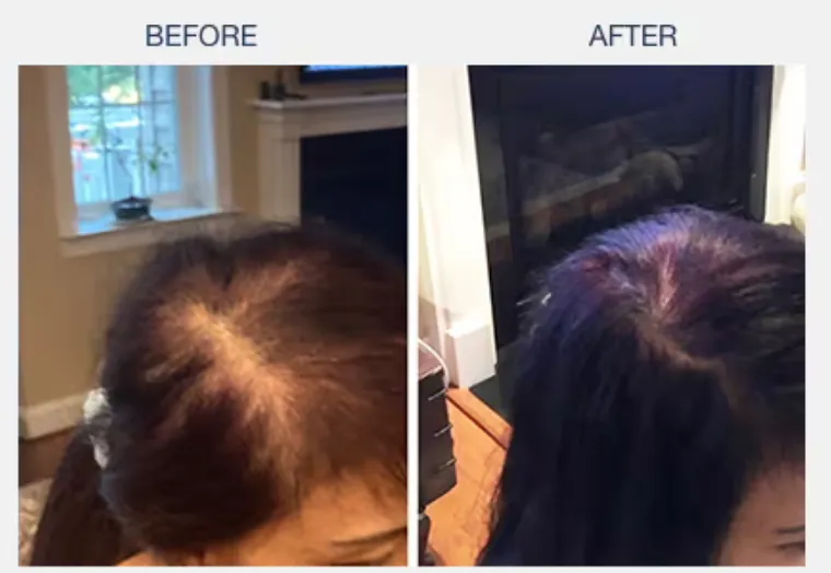 illumiflow 272 Laser Cap for Hair Growth before and after results