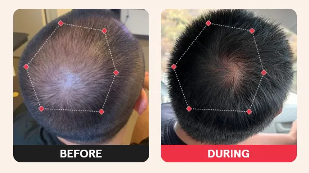 iRestore Laser Cap – Before and After Photos