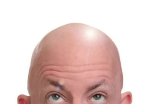 Identifying the Factors Behind Shiny Bald Head